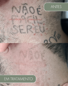 Remoção de Tatuagem Adeus Tattoo