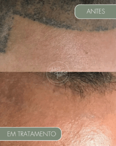 Remoção de Tatuagem Adeus Tattoo