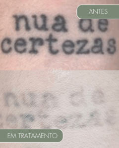 Remoção de Tatuagem Adeus Tattoo
