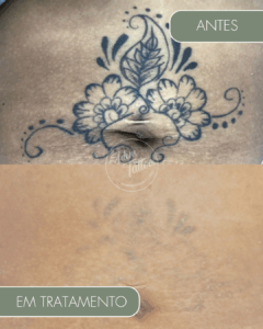Remoção de Tatuagem Adeus Tattoo