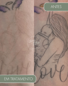 Remoção de Tatuagem Adeus Tattoo