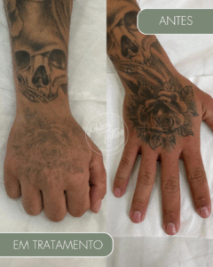 Remoção de Tatuagem Adeus Tattoo