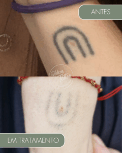 Remoção de Tatuagem Adeus Tattoo