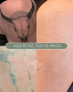 Remoção de Tatuagem Adeus Tattoo