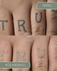 Remoção de Tatuagem Adeus Tattoo