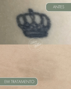 Remoção de Tatuagem Adeus Tattoo